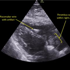 Wolff A et al. Right atrial thrombosis. Parasternal long US 3 annotated