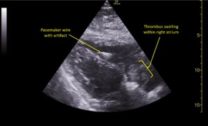 Wolff A et al. Right atrial thrombosis. Parasternal long US 3 annotated