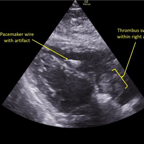 Right Atrial Rupture A Case Report of Right Atrial Thrombosis Complicated by Multiple ...