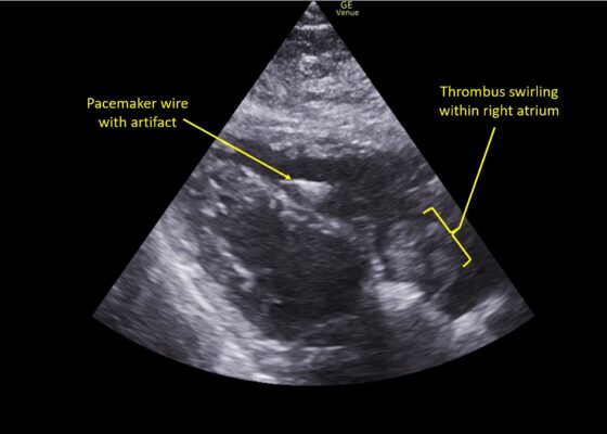 Wolff A et al. Right atrial thrombosis. Parasternal long US 3 annotated