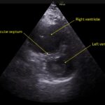 Wolff A et al. Right atrial thrombosis. Parasternal short US 1 annotated