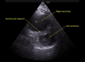Wolff A et al. Right atrial thrombosis. Parasternal short US 1 annotated
