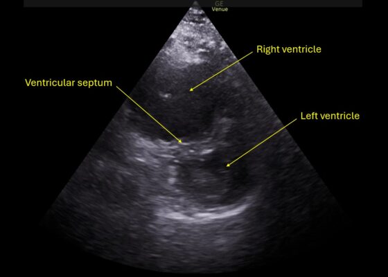 Wolff A et al. Right atrial thrombosis. Parasternal short US 1 annotated