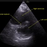 Wolff A et al. Right atrial thrombosis. Parasternal short US 2 annotated