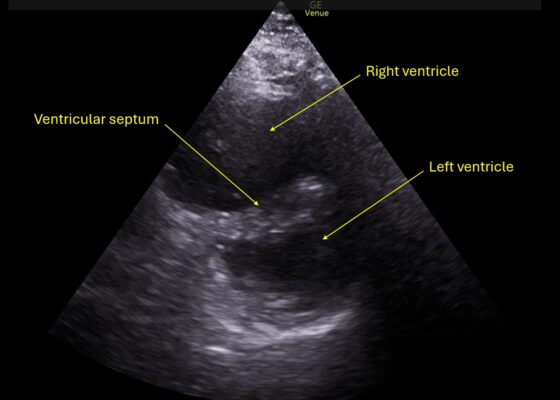 Wolff A et al. Right atrial thrombosis. Parasternal short US 2 annotated