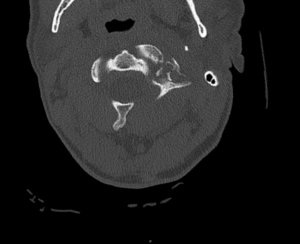 CSpine Fracture CT Axial Unannotated. JETem 2025
