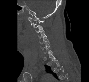 CSpine Fracture CT Sagital Unannotated. JETem 2025
