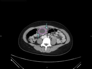 Hydropic Gallbladder. CT Axial Annotated. JETem 2025