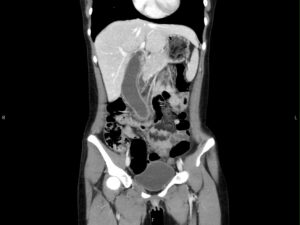 Hydropic Gallbladder. CT Coronal Unannotatd. JETem 2025