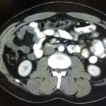 Iatrogenic Bowel Perforation Following Dental Procedure. CT. Annotated. JETem 2025