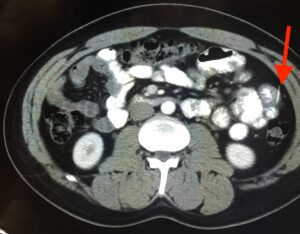 Iatrogenic Bowel Perforation Following Dental Procedure. CT. Annotated. JETem 2025