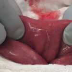 Iatrogenic Bowel Perforation Following Dental Procedure. CT. IntraOp Photo. JETem 2025