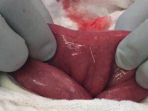 Iatrogenic Bowel Perforation Following Dental Procedure. CT. IntraOp Photo. JETem 2025