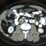 Iatrogenic Bowel Perforation Following Dental Procedure. CT. Unannotated. JETem 2025