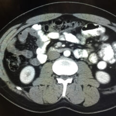 Iatrogenic Bowel Perforation Following Dental Procedure. CT. Unannotated. JETem 2025