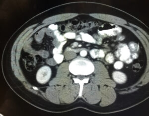 Iatrogenic Bowel Perforation Following Dental Procedure. CT. Unannotated. JETem 2025