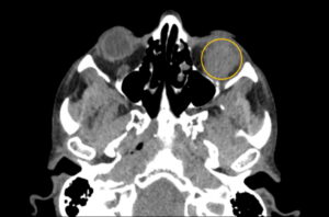 Inferior Rectus Abscess CT Axial Annotated. JETem 2025