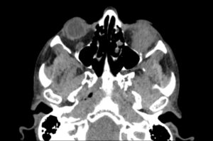 Inferior Rectus Abscess CT Axial Unannotated. JETem 2025