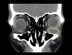 Inferior Rectus Abscess CT Coronal Annotated. JETem 2025