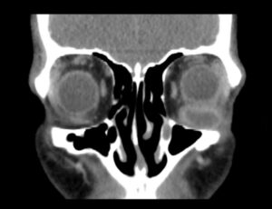 Inferior Rectus Abscess CT Coronal Unannotated. JETem 2025