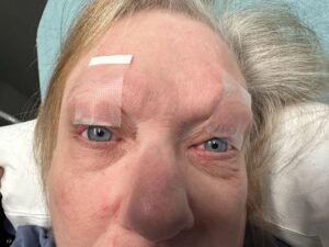 Myasthenia Gravis Eyes Taped Open. JETem 2025