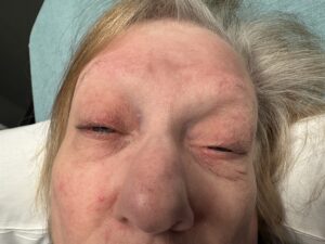 Myasthenia Gravis Eyes. JETem 2025