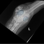 Calcinosis Cutis. Elbow XR AP Annotated. JETem 2025