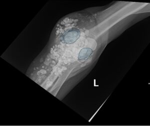 Calcinosis Cutis. Elbow XR AP Annotated. JETem 2025