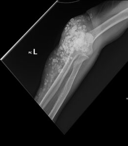 Calcinosis Cutis. Elbow XR External Oblique. JETem 2025