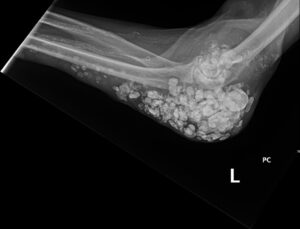 Calcinosis Cutis. Elbow XR Lateral. JETem 2025