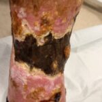 Calciphylaxis Photo LLE. JETem 2025 1