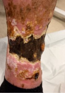 Calciphylaxis Photo LLE. JETem 2025 1