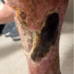 Calciphylaxis Photo RLE. JETem 2025
