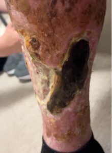 Calciphylaxis Photo RLE. JETem 2025