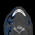Dental Free Air CT Axial Annotated. JETem 2025