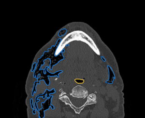Dental Free Air CT Axial Annotated. JETem 2025