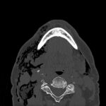 Dental Free Air CT Axial Unannotated. JETem 2025