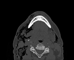 Dental Free Air CT Axial Unannotated. JETem 2025