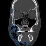 Dental Free Air CT Coronal Annotated. JETem 2025