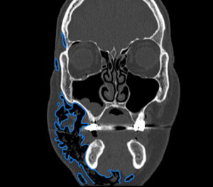Dental Free Air CT Coronal Annotated. JETem 2025
