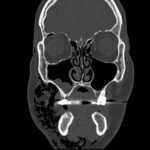 Dental Free Air CT Coronal Unannotated. JETem 2025