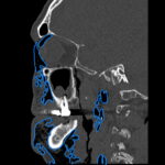 Dental Free Air CT Sagitial Annotated. JETem 2025