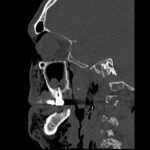 Dental Free Air CT Sagitial Unannotated. JETem 2025