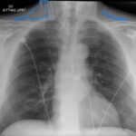 Dental Free Air CXR 2 Annotated. JETem 2025