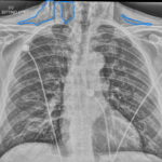 Dental Free Air CXR 2 Inverted Annotated. JETem 2025
