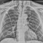 Dental Free Air CXR 2 Inverted Unannotated. JETem 2025