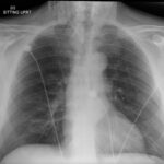 Dental Free Air CXR 2 Unannotated. JETem 2025