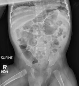Incarcerated Gastric Volvulus and Splenic Herniation. Abdominal Radiograph Postoperative Day 33. JETem 2025