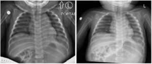 Incarcerated Gastric Volvulus and Splenic Herniation. Chest Radiographs on Postoperative Days 1 and 4. Unannotated. JETem 2025