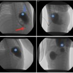 Incarcerated Gastric Volvulus and Splenic Herniation. Upper GI. Annotated. JETem 2025